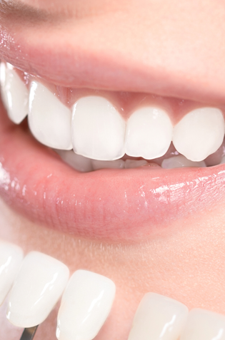 In Chair Vs Take Home Teeth Whitening Nedlands Dental