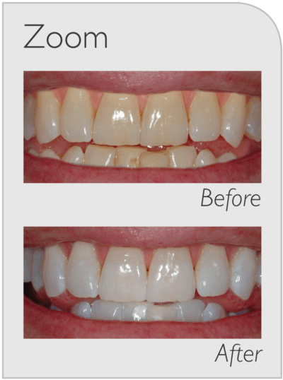 Before and after Zoom Teeth Whitening